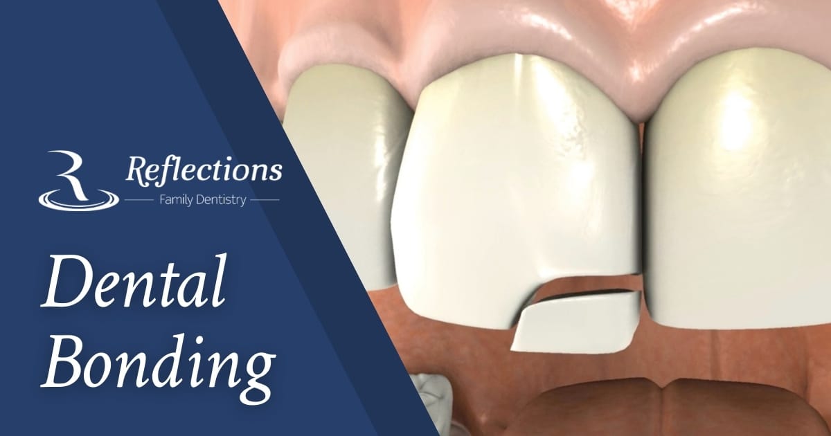 Dental Bonding — Reflections Family Dentistry — Granite Bay, CA