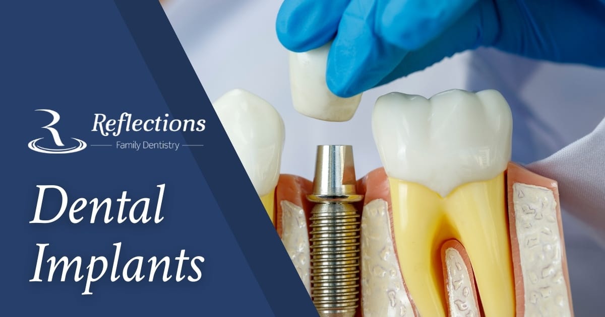 Dental Bonding and Veneering  Gentle Family Dentist Avondale and Dental  Implants