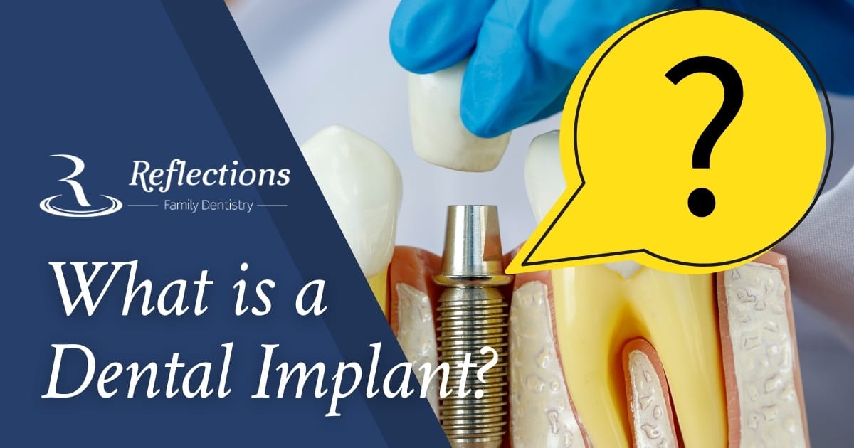 Dental Implant — Replace Missing or Failing Teeth — Reflections Family ...