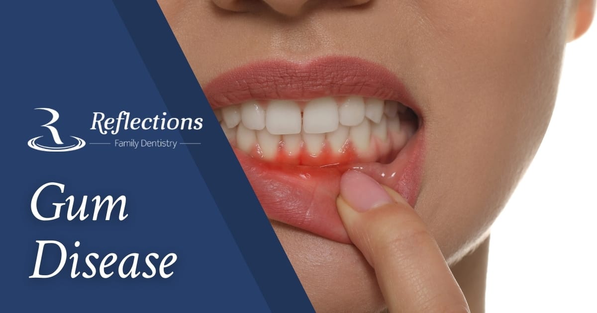 Gum Disease — Reflections Family Dentistry — Granite Bay, CA